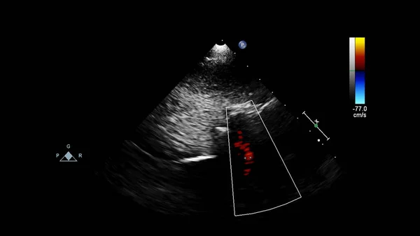 Bild Des Herzens Beim Transesophagealen Ultraschall Mit Doppler Modus — Stockfoto