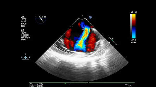 Imagem Coração Durante Ultrassom Transesofágico Com Modo Doppler — Fotografia de Stock