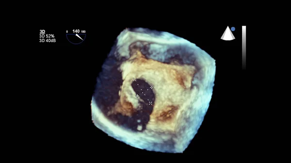 经食管超声检查心脏3D图像 — 图库照片