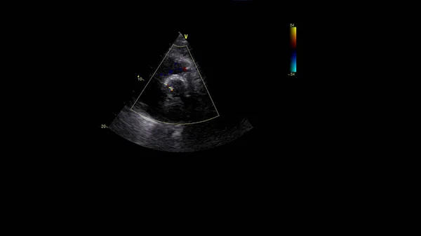 Imagem Coração Durante Ultrassom Transesofágico Com Modo Doppler — Fotografia de Stock