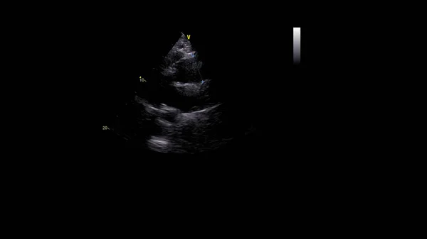 経食道超音波検査時のグレースケールモードで心臓の画像 — ストック写真