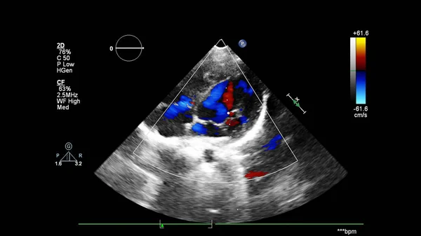 Immagine Del Cuore Durante Ecografia Transesofagea Con Modalità Doppler — Foto Stock