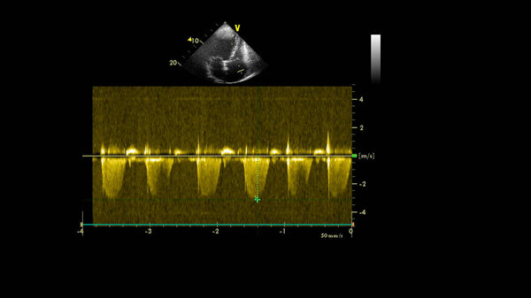 Изображение сердца в сером режиме во время трансофагеального ультразвука.
