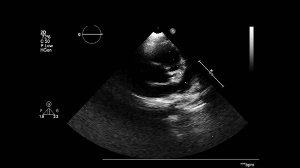 Afbeelding Van Het Hart Grijs Schaal Modus Tijdens Transesofageale Echografie — Stockfoto