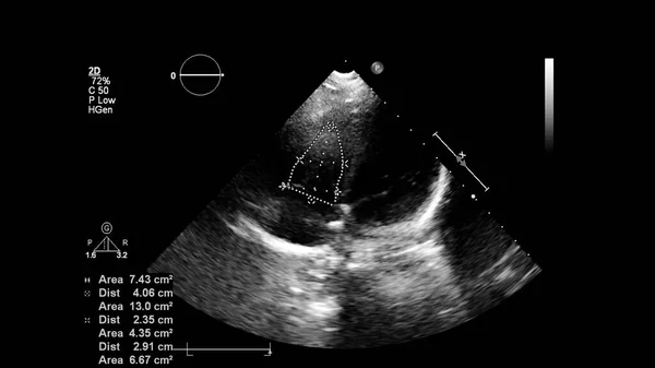 Image Heart Gray Scale Mode Transesophageal Ultrasound — Stock Photo, Image