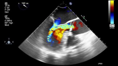 Kalbin ultrason transsofageal muayenesi.