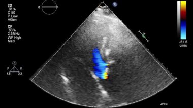 Kalbin ultrason transsofageal muayenesi.