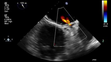 Kalbin ultrason transsofageal muayenesi.