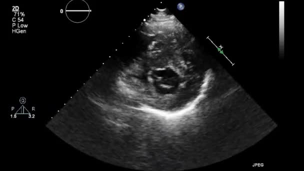Ultraljudstransesofageal Undersökning Hjärtat — Stockvideo