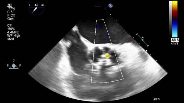 Kalbin Ultrason Transsofageal Muayenesi — Stok video