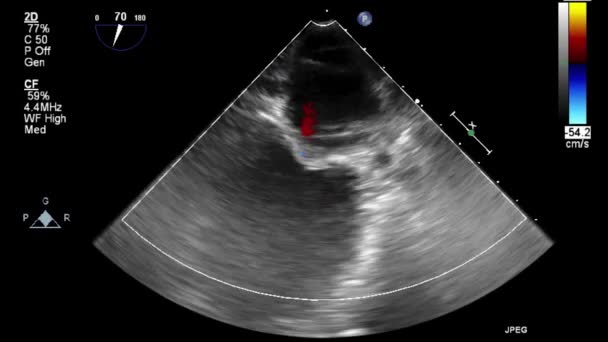 Ecografia Esame Transesofageo Del Cuore — Video Stock