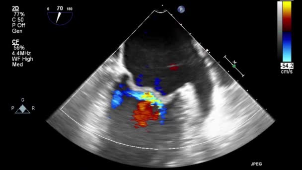 Szív Ultrahangos Transznyelőcső Vizsgálata — Stock videók