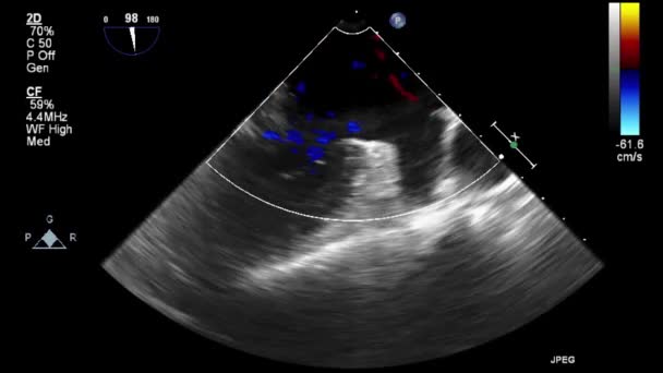 Ultrasound Transesophageal Examination Heart — Stock Video