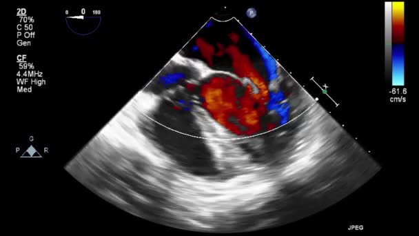 Ultrasound Transesophageal Examination Heart — Stock Video