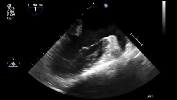Ultrasound Transesophageal Examination Heart — Stock Video