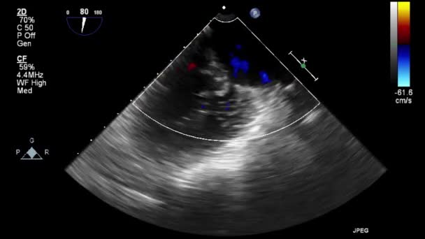 Ultraschall Transesophageale Untersuchung Des Herzens — Stockvideo