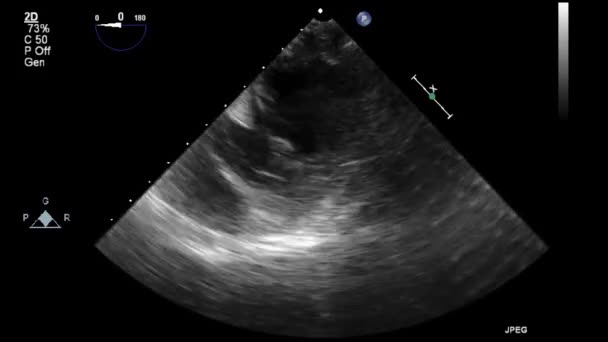 Ultrasound Transesophageal Examination Heart — Stock Video