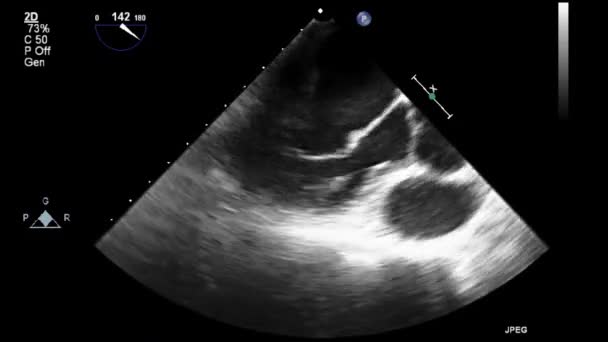 Ecografía Examen Transesofágico Del Corazón — Vídeos de Stock
