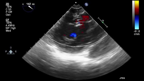 Ultraschall Transesophageale Untersuchung Des Herzens — Stockvideo