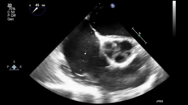 Kalbin Ultrason Transsofageal Muayenesi — Stok video