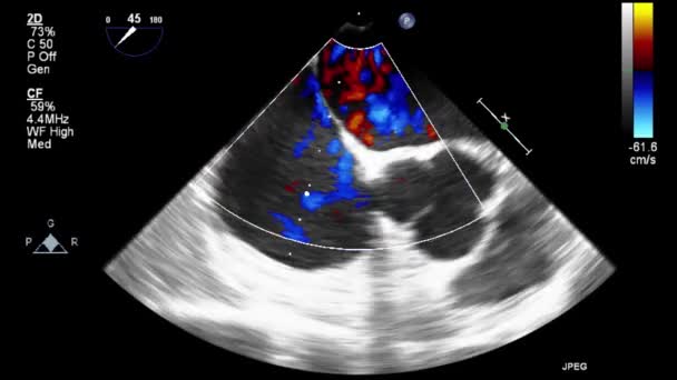 Ultrasound Transesophageal Examination Heart — Stock Video