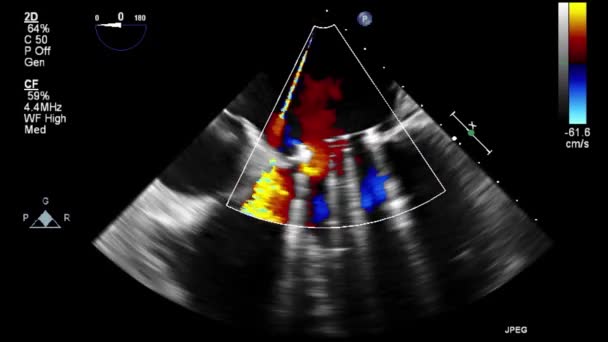 Ultraschall Transesophageale Untersuchung Des Herzens — Stockvideo