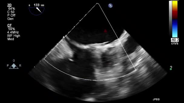 Ultrasound Transesophageal Pemeriksaan Jantung — Stok Video