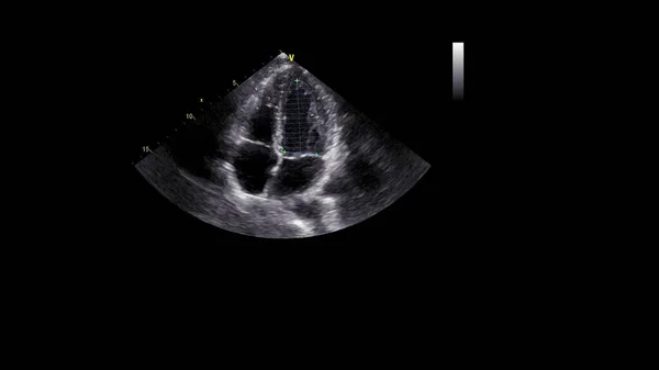 Transesofageal Ultrason Sırasında Kalbin Gri Ölçekli Görüntüsü — Stok fotoğraf