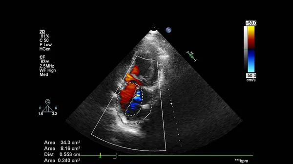 Imagen Del Corazón Durante Ecografía Transesofágica Con Modo Doppler — Foto de Stock