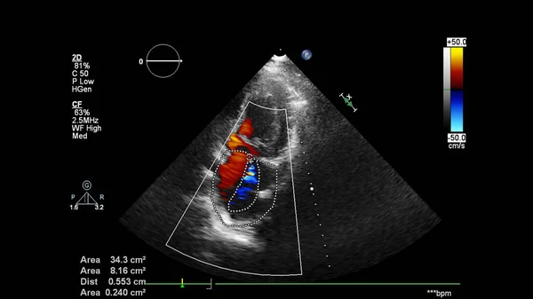 Imagen Del Corazón Durante Ecografía Transesofágica Con Modo Doppler — Foto de Stock