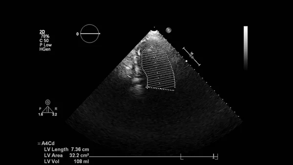 经食管超声下灰度型心脏影像学 — 图库照片