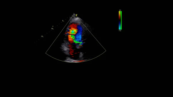 Transesofageal Ultrason Sırasında Doppler Kipi Ile Kalbin Görüntüsü — Stok fotoğraf