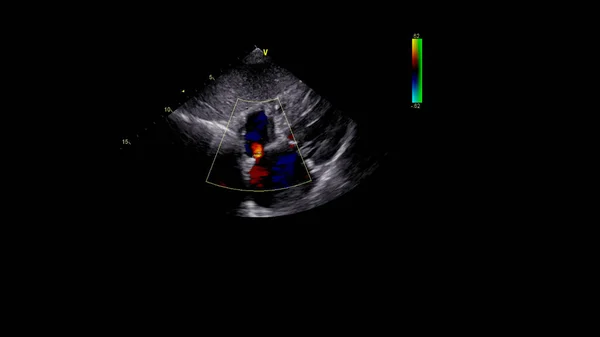 Imagem Coração Durante Ultrassom Transesofágico Com Modo Doppler — Fotografia de Stock