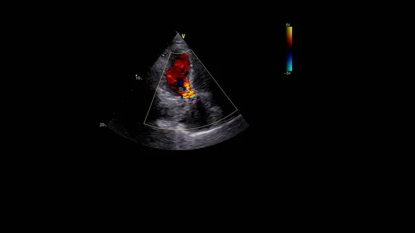 Transesofageal Ultrason Sırasında Doppler Kipi Ile Kalbin Görüntüsü — Stok fotoğraf