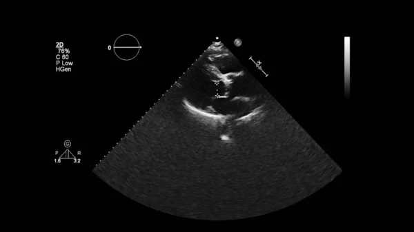 Imagem Coração Escala Cinza Durante Ultrassonografia Transesofágica — Fotografia de Stock