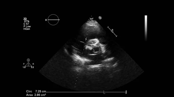 Image of the heart in gray-scale mode during transesophageal ultrasound.