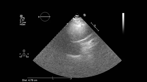 Obrázek Srdce Šedém Měřítku Během Transesofageálního Ultrazvuku — Stock fotografie