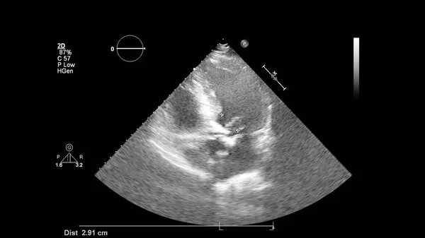 Image Heart Gray Scale Mode Transesophageal Ultrasound — Stock Photo, Image