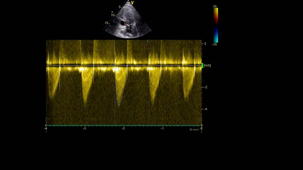 Imagem Coração Durante Ultrassom Transesofágico Com Modo Doppler — Fotografia de Stock