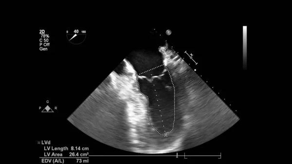 Image of the heart in gray-scale mode during transesophageal ultrasound.