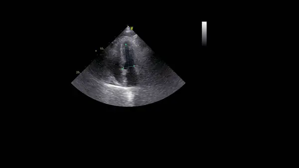 Imagem Coração Escala Cinza Durante Ultrassonografia Transesofágica — Fotografia de Stock