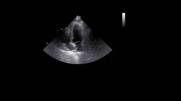 Изображение Сердца Сером Режиме Время Трансофагеального Ультразвука — стоковое фото