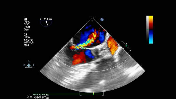 Immagine Del Cuore Durante Ecografia Transesofagea Con Modalità Doppler — Foto Stock