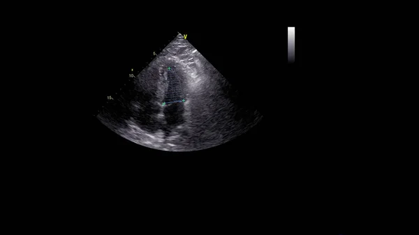 Image Heart Gray Scale Mode Transesophageal Ultrasound — Stock Photo, Image