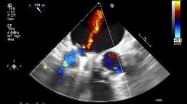Kalbin ultrason transsofageal muayenesi.