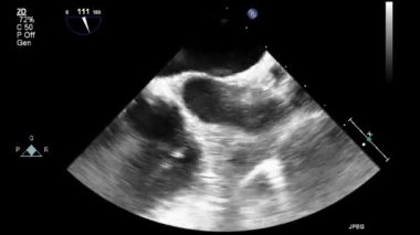 Kalbin ultrason transsofageal muayenesi.