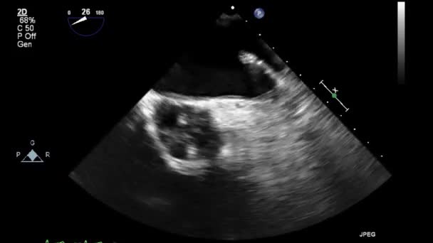 Exame Transesofágico Ultrassonográfico Coração — Vídeo de Stock