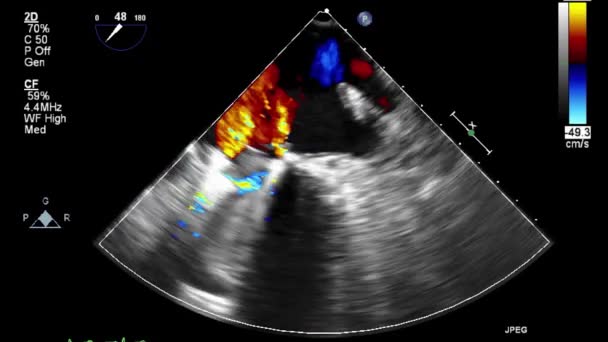 Ecografía Examen Transesofágico Del Corazón — Vídeos de Stock