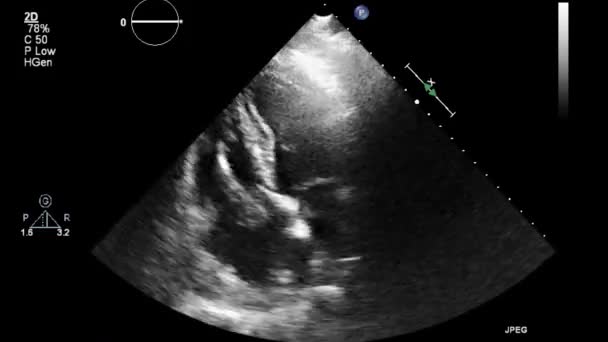 Ultraljudstransesofageal Undersökning Hjärtat — Stockvideo