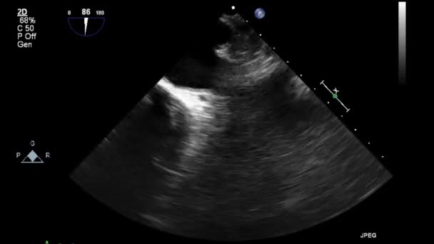 Ecografía Examen Transesofágico Del Corazón — Vídeos de Stock